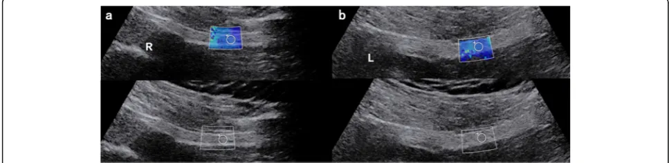 Fig. 3 A 30-year-old male patient with complaints of sciatalgia for 12 months and VAS scores was 6