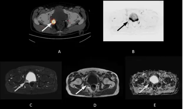 Figure 2: 68-year-old patient with local recurrence 13 years after radical prostatectomy (initial Gleason Score: 8)