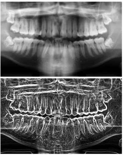 Figure 1 - In the upper panel, we can see a basic panoramic radiograph showing impacted wisdom teeth in a 16 year old