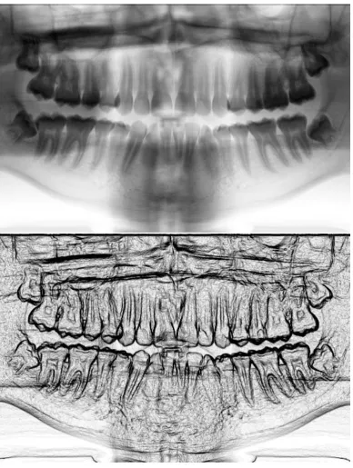 Figure 2 - In the upper panel, we can see the panoramic radiograph of Figure 1 with inverted color tones, as obtained by GIMP