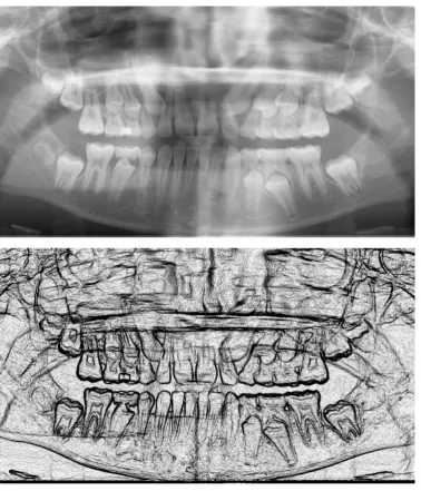 Figure 3 – In the upper panel we can see a panoramic radiograph which is showing the mixed dentition of a nine year old child (courtesy Coronation Dental Specialty Group on Wikipedia)