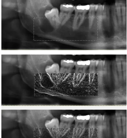 Figure 4 - In the upper panel, we can see a basic panoramic radiograph showing  a jaw cyst in the right mandible selecting an area and processing just the selected region