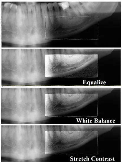 Figure 6 – Panoramic radiographs are routinely used in pre-surgical evaluation. In them, the pattern of  mandibular canal and the mental foramen are important landmarks