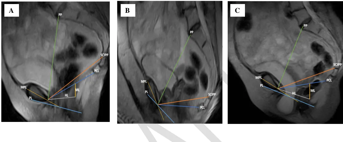 Fig. 4. Sagittal open magnetic resonance imaging midline views of the female pelvis obtained in the standing position (with reference lines) showing in (A) no evidence of pelvic organ prolapse (POP) in a 26-year-old control (asymptomatic) subject; and (B) 