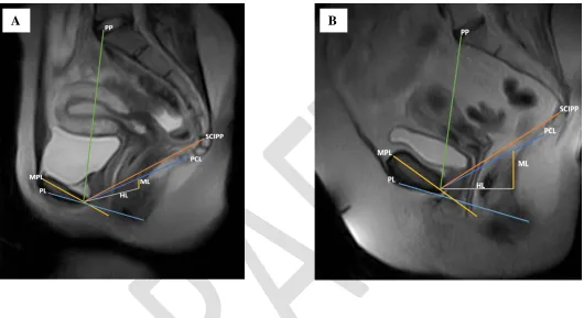 Fig. 5. Sagittal open magnetic resonance imaging midline views of the female pelvis obtained in measurement of reference line lengths; the supine position: (A) Midsagittal T2-weighted image of a 27-year-old control subject with (B) Midsagittal T2-weighted 