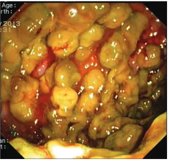 Figure 1: Abdominal computer tomography shows diffuse irregularmural thickening of the large bowel loops with scattered mucosaland submucosal hyperdensity suggestive of hemorrhage.