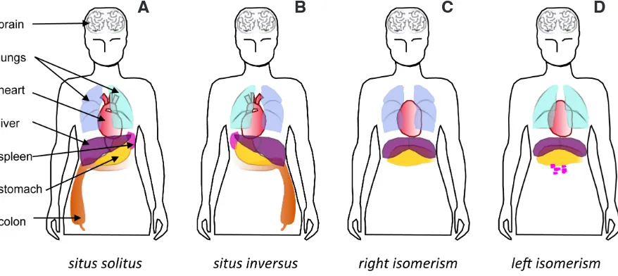 Fig. 2. Laterality in humans: situs solitus and some situs alterations. Many organs are arranged asymmetrically along the LR axis within the human body cavity