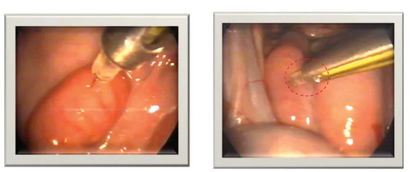Figure 6. Correct laparoscopic semen deposition at the least vascular location of the ewe’s  uterus