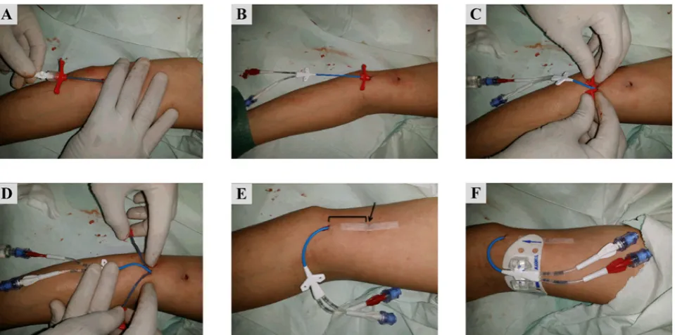 Figure 2. (A) Needle tip exiting the original puncture site. (B) The guidewire threaded into the needle as it is slowly withdrawn
