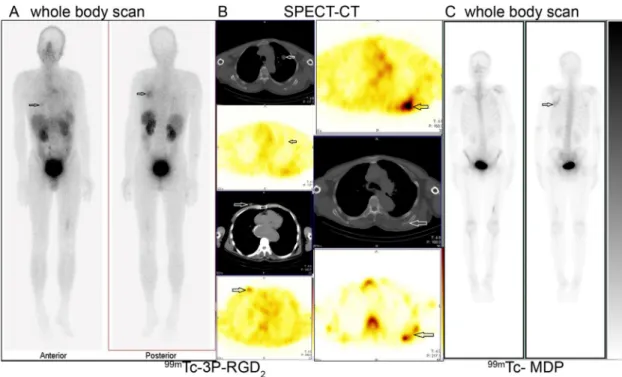 Figure 4:  99m Tc-3P-RGD