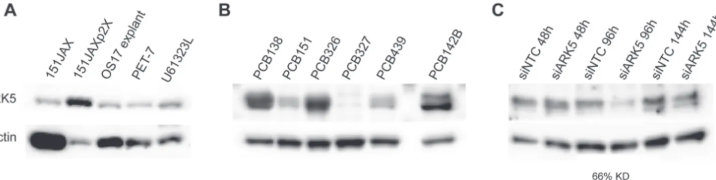 Figure 5: ARK5 expression is present within source tumors and is prevalent in human osteosarcomas