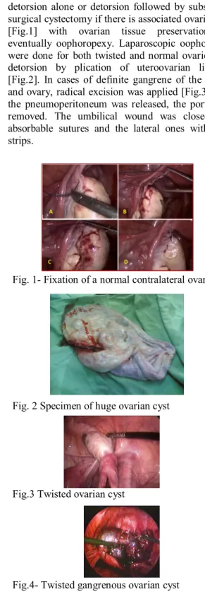 Fig. 1- Fixation of a normal contralateral ovary  