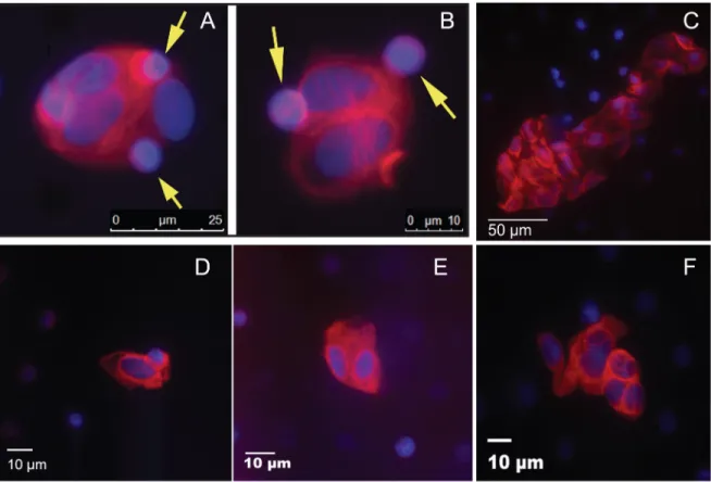 Figure 3: CTC from sarcoma patients.  CTC isolated from the blood of (A and B) a 38 year old man with a primary refractory  localized paraspinal Ewing sarcoma, (C) a 17 year old girl with recurrent osteosarcoma, (D) a 3 year old boy with newly diagnosed  a