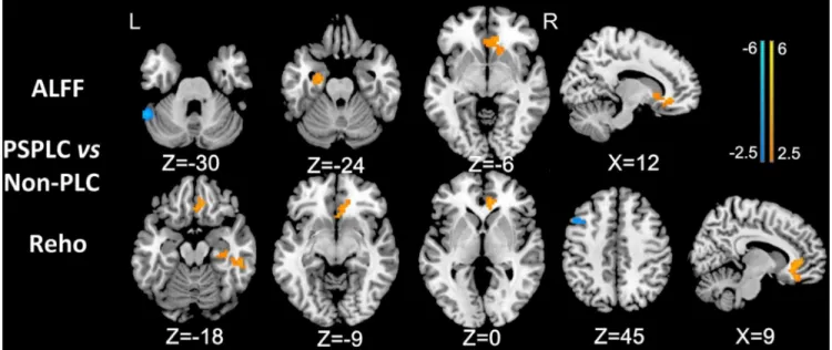 Figure 3: Differences in ALFF and ReHo values between PSPLC patients and non-PLC patients (P < 0.01, AlphaSim  corrected)
