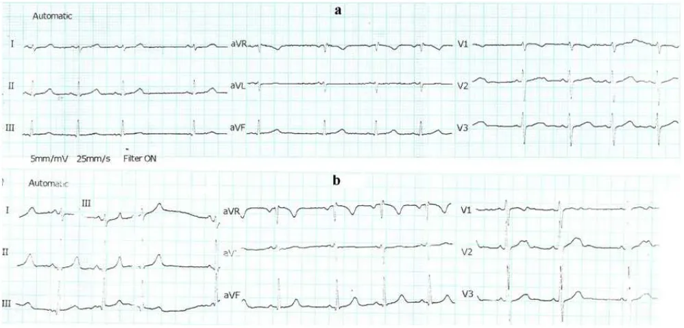 Fig. 1-4 presents the ECG results two experimental groups before and after training.of four students from  