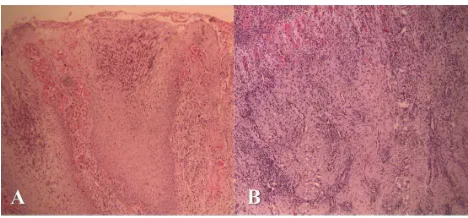 Fig 5. A. Histopathologic view of digital lesion (after 4 weeks), hyperemia, inflammation decreased and evidences of proper healing of epidermis are observed (H&E, × 100)