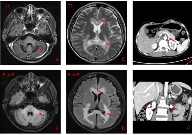 Figure 1: Results of brain magnetic resonance imaging and abdominal computed tomography