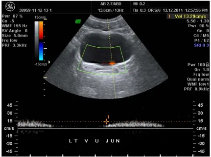 Figure 2. Color Doppler sonography of the right ureteric jet of a healthy subject with the sample box of the pulsed Doppler is adjusted at the right vesico-ureteric orifice (peak velocity = 35.8 cm/s)