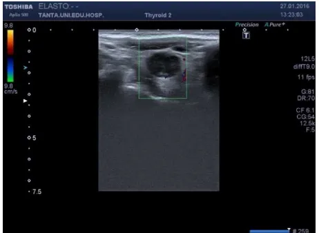Figure 4. Case 1: color elastogram of enlarged cervical lymph node gives pattern 2 elastography score and strain ratio is 1.25