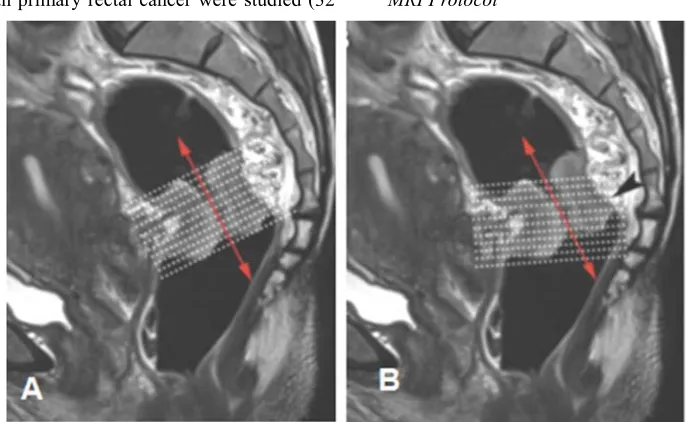 Figure 1. Sagittal T2-weighted image used for planning high-resolution T2 sequence. (A) Plane of planned images (white dotted lines) is perpendicular to the axis of rectum/tumor (red arrow [A, B])