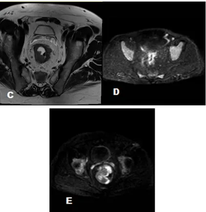 Figure 3. (A) Sagittal T2 WI: Demonstrates the site of the rectal tumor at the middle and the upper third of the rectum