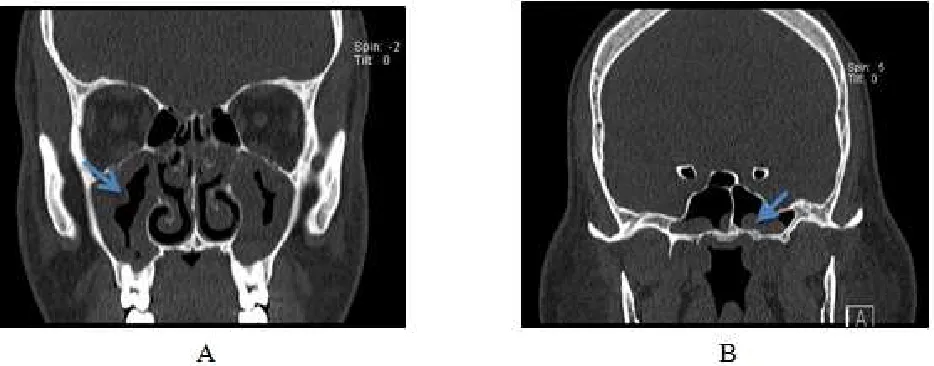 Fig. 1. The distribution of different patterns of sinusitis among the study group. 