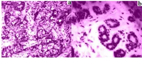 Figure 1. Staining of FHIT (SP, ×200). a: breast cancer tissue; b: normal breast tissue