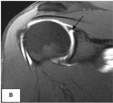 fig. 4 C broad arrow).  Biceps tenosynovitis (3 patients) and 