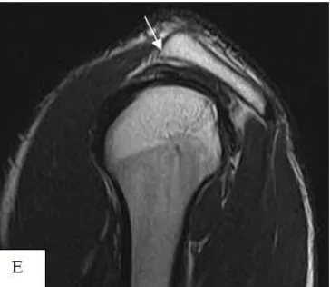 Fig. 4 (A-E). Male patient complaining of shoulder pain of two years duration and one attack of dislocation following direct trauma 4 months ago