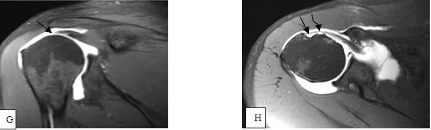 Fig. 5 (A-H). Male patient 53 years, complaining of shoulder pain and limitation of movement for about 10 years duration which became recently more severe