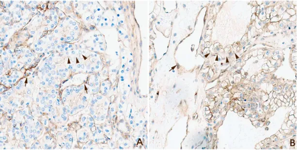 Figure 1: Examples of myoferlin staining grades. (A) Myoferlin hypoexpression. Clear cell renal cell carcinoma (ccRCC) cells  revealed weaker expression compared with capillary endothelial cells (arrow, endothelial cells; arrow head, ccRCC cells; Magnifica