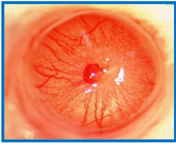 Figure 4. Corneal angiogenesis assay[92]