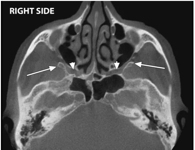Figure 1. Axial multiplanar reconstructions in which there are observed bilateral sphenoidal tubercles (arrows) obstructing the entrances in the pterygopalatine fossae (arrowheads).