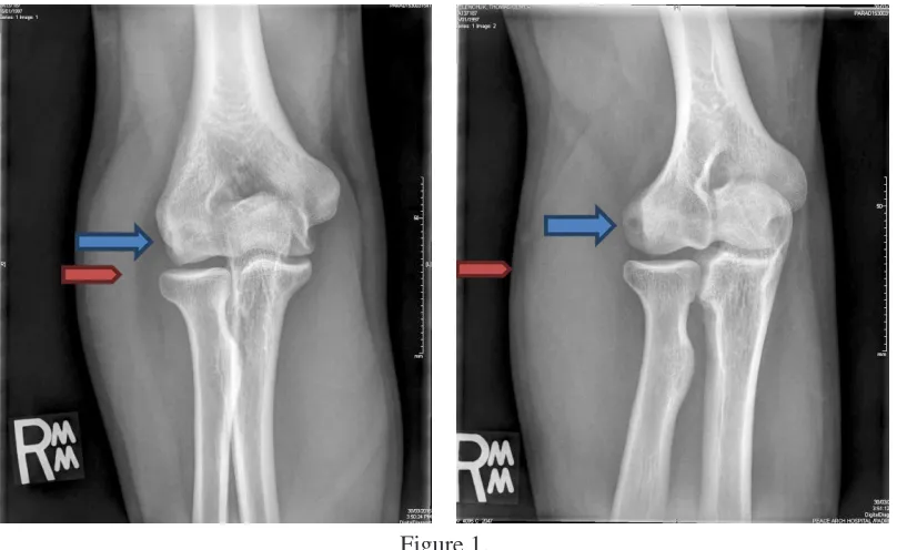 Figure 1. Plain radiographs of the elbow prior to surgical intervention. 