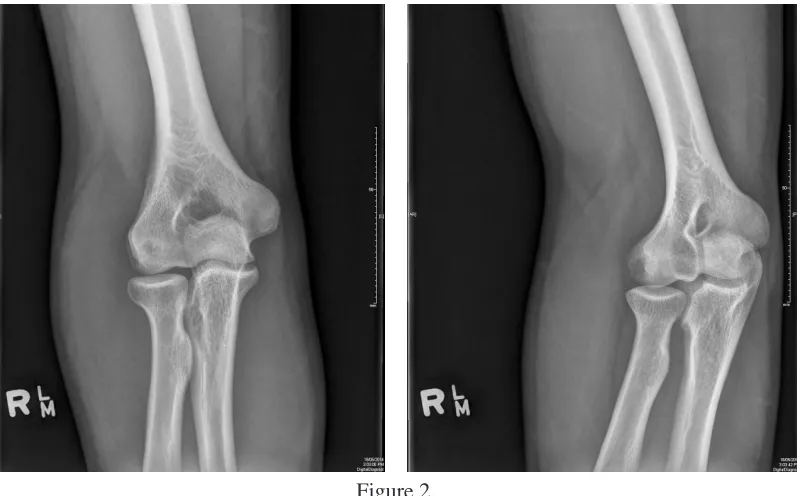 Figure 2. Plain radiographs of the elbow 7 months post-surgical intervention. 