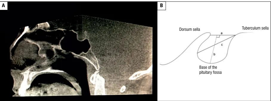 Figure 1. The axial, sagittal and coronal slices of from cone-beam computed tomography images used to evaluate the volume of the sella by Romexis programme® 2.9.2.R.