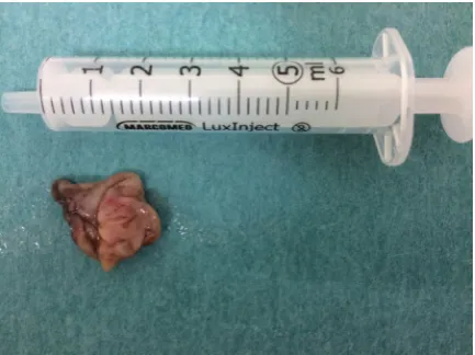 Figure 4. Sagittal section, left side. Visible characteristic structure of teeth with dysplasia type I and root cyst (an arrow) indenting into the lumen of the left sinus (visible above the first left upper molar tooth).