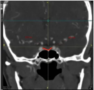 Figure 2. The measurement of intercarotid distance (computed tomography angiography).