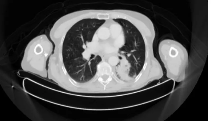 Figure  2.2:  The  CT  image  of  the  lung  field  from  a  NSCLC patient (data description detailed in Chapter 5)