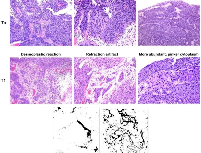 Fig. 3. The three key patterns for distinguishing non-invasive versus invasive bladder tumors