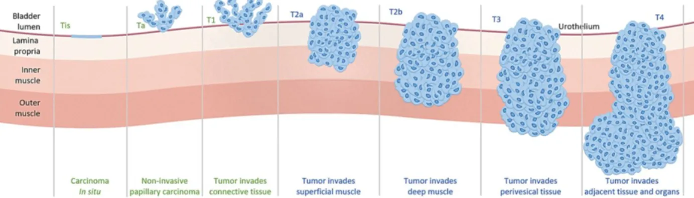 Fig. 1. Staging of bladder cancer 