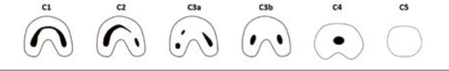Figure 2. C-shaped root canal configurations according to Fan et al. [4]. C1 — uninterrupted C-shaped canal; C2 — semi-colon shaped canal; C3 — two or three separate canals; C4 — only one round or oval canal; C5 — no observable canal lumen.