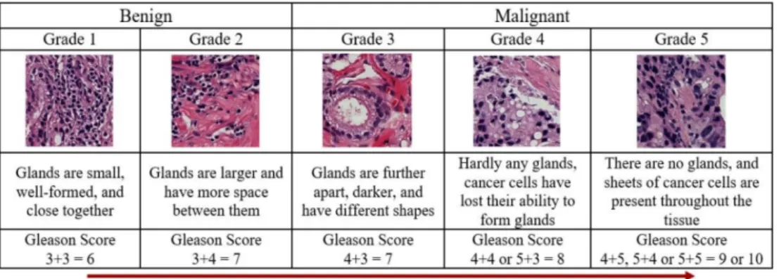 Figure 1. Gleason scores and prostate cancer grading system. The Gleason score for cancer grading is  computed by adding the primary and secondary scores from a whole slide H&amp;E-stained microscopic  biopsy image
