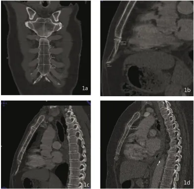 Figure 1. Measurements of sternum performed on multislice computed tomography images. A