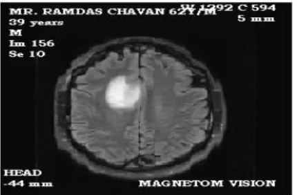 Figure 1.1 shows an MRI image of tumour affected brain.  