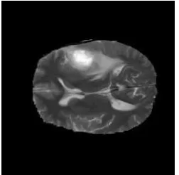 Figure 4.2 MRI Image after noise removal using median filter 