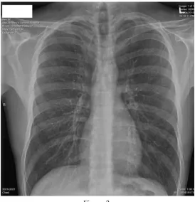 Figure 2. Two weeks after tube inserted there is a complete resolution of pneumothorax.