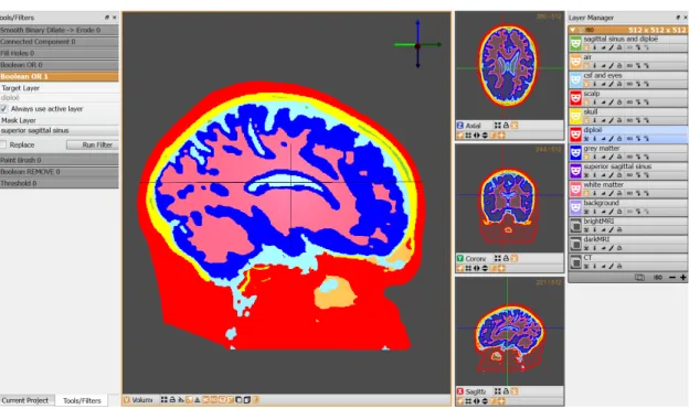 Figure 3.1: The Seg3D workspace after completed CT&amp;MRI segmentation - Screenshot of the Seg3D workspace after completed segmentation of the CT and MRI scan
