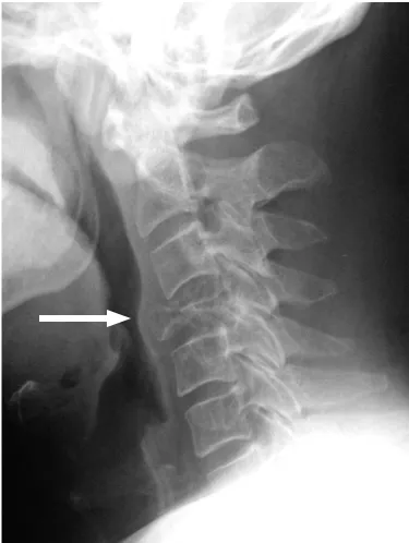 Figure 3. Lateral Cervical Spine Plain 