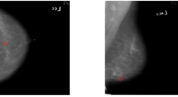 Figure 1: Mammography with two views on the left chest of the same patient. 
